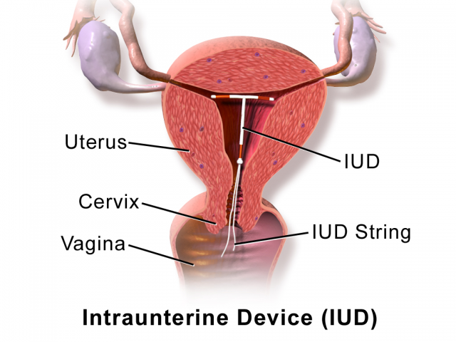 2018723-https---en.wikipedia.org-wiki-Intrauterine_device