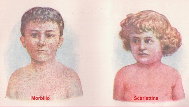 1951902-http---blog.bimbonaturale.org-la-scarlattina-nel-bambino-sintomi-cause-visione-naturopatica-trattamento-rimedi-naturali-